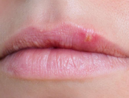 Dry Lips Causes, How to  pull off Rid of Chapped Lips Fast and  